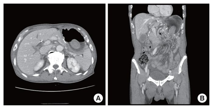 Jejunogastric intussusception after totally laparoscopic distal gastrectomy for gastric cancer: a rare case report and review of the literature.