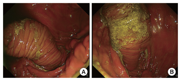 Jejunogastric intussusception after totally laparoscopic distal gastrectomy for gastric cancer: a rare case report and review of the literature.