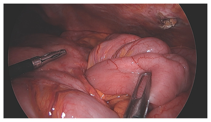 Jejunogastric intussusception after totally laparoscopic distal gastrectomy for gastric cancer: a rare case report and review of the literature.