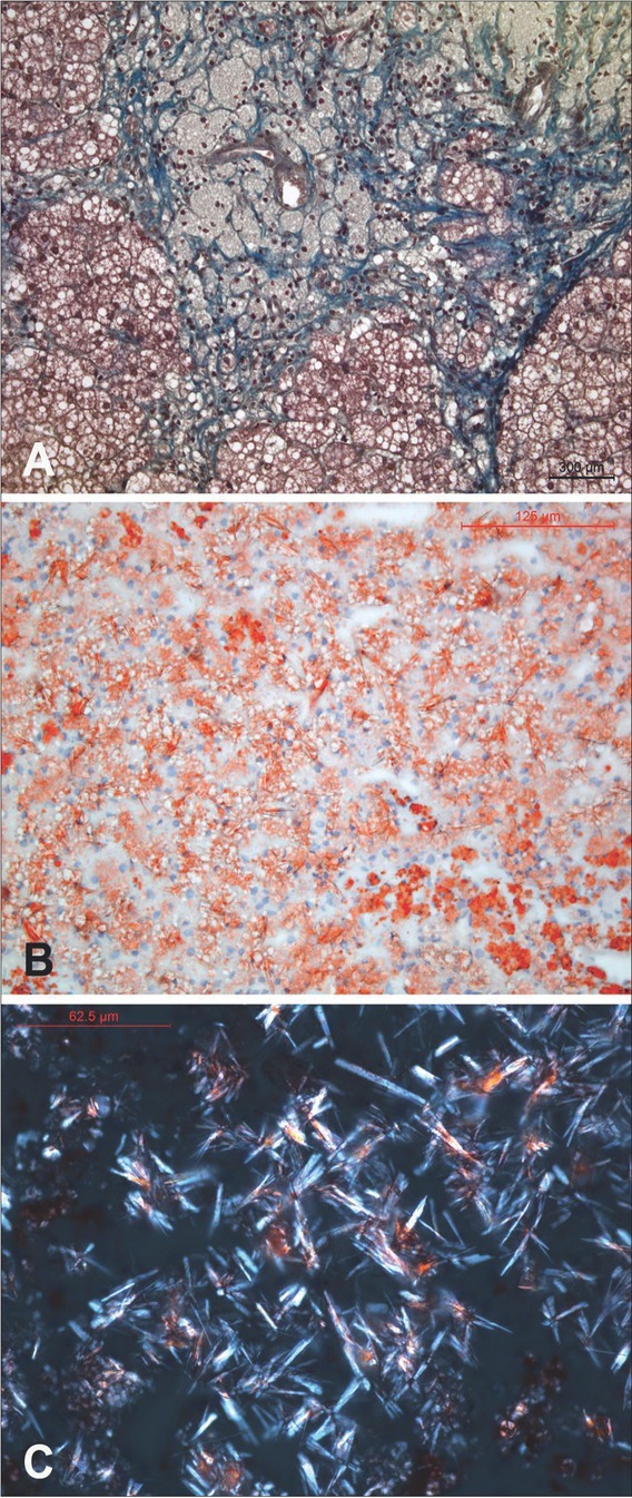 A Novel Variant in the <i>LIPA</i> Gene Associated with Distinct Phenotype.