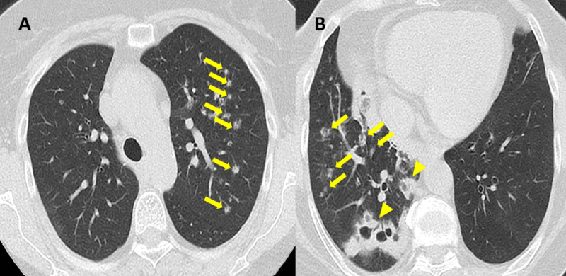 Lung Adenocarcinoma Mimicking a Bilateral Cavitary Pneumonia.