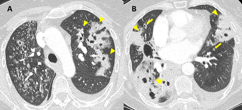 Lung Adenocarcinoma Mimicking a Bilateral Cavitary Pneumonia.