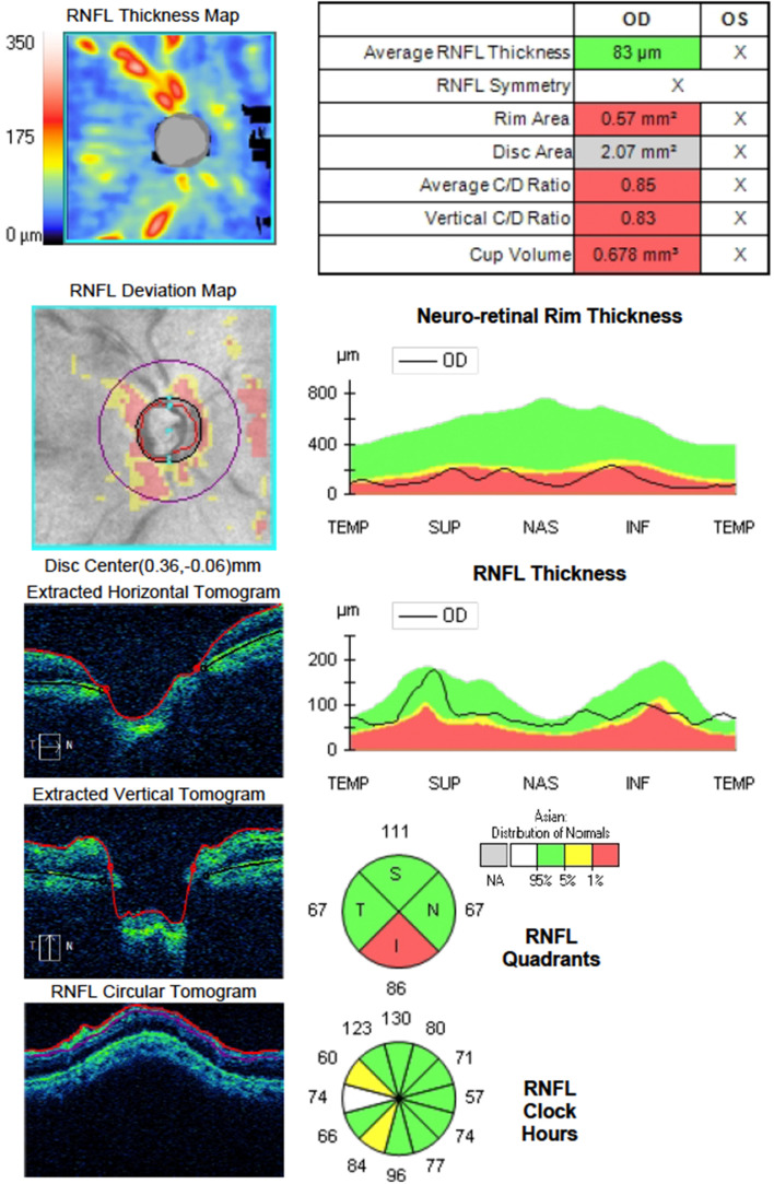 Combined central retinal artery and vein occlusion following trabeculectomy.