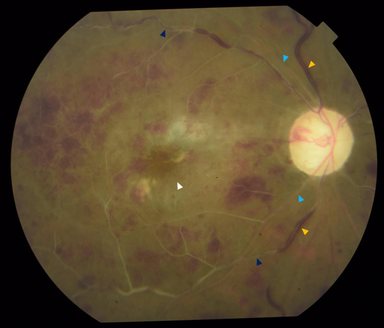 Combined central retinal artery and vein occlusion following trabeculectomy.