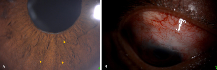 Combined central retinal artery and vein occlusion following trabeculectomy.