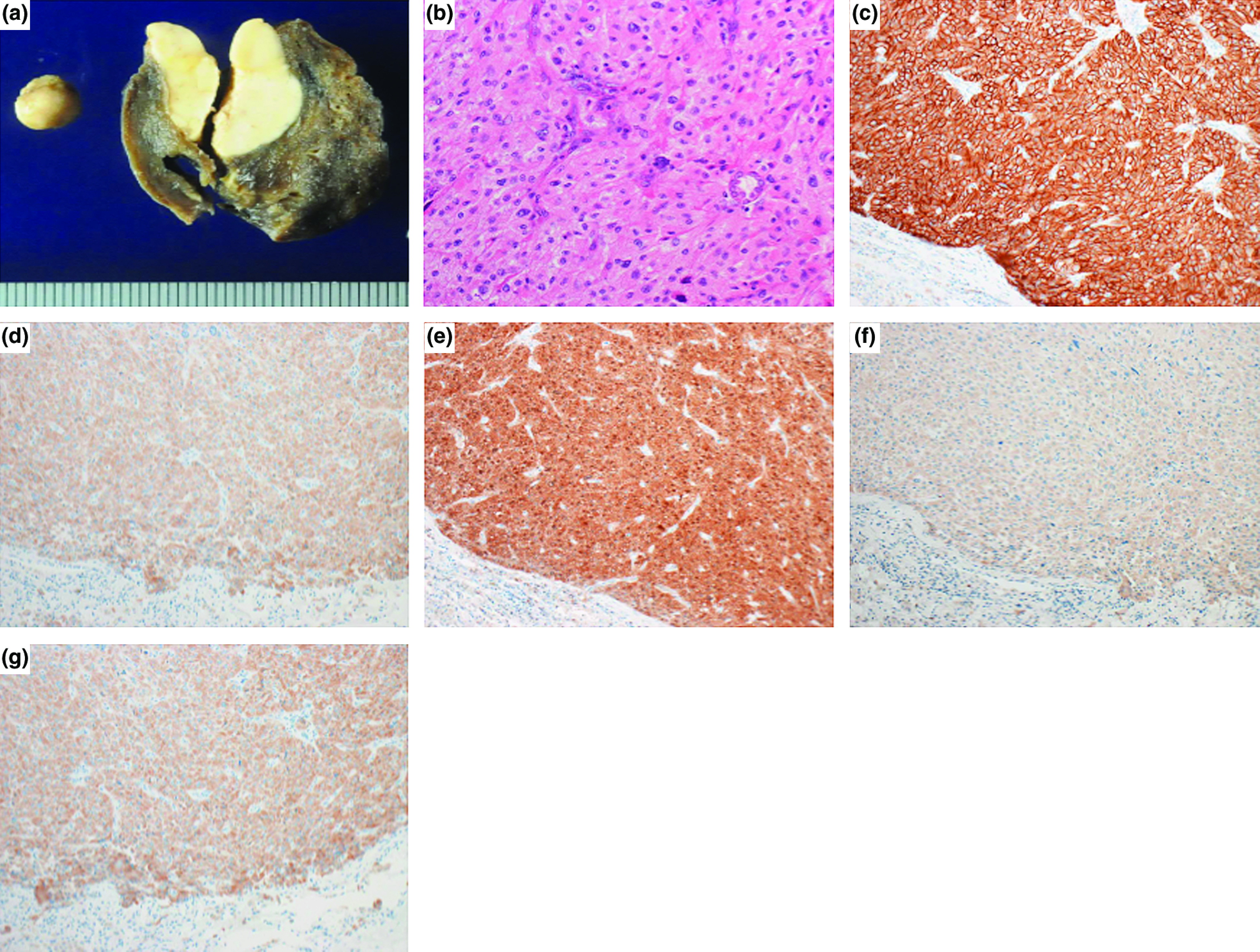 Resection of Pulmonary Metastases 12 Years after Initial Surgery for a Benign Pheochromocytoma.