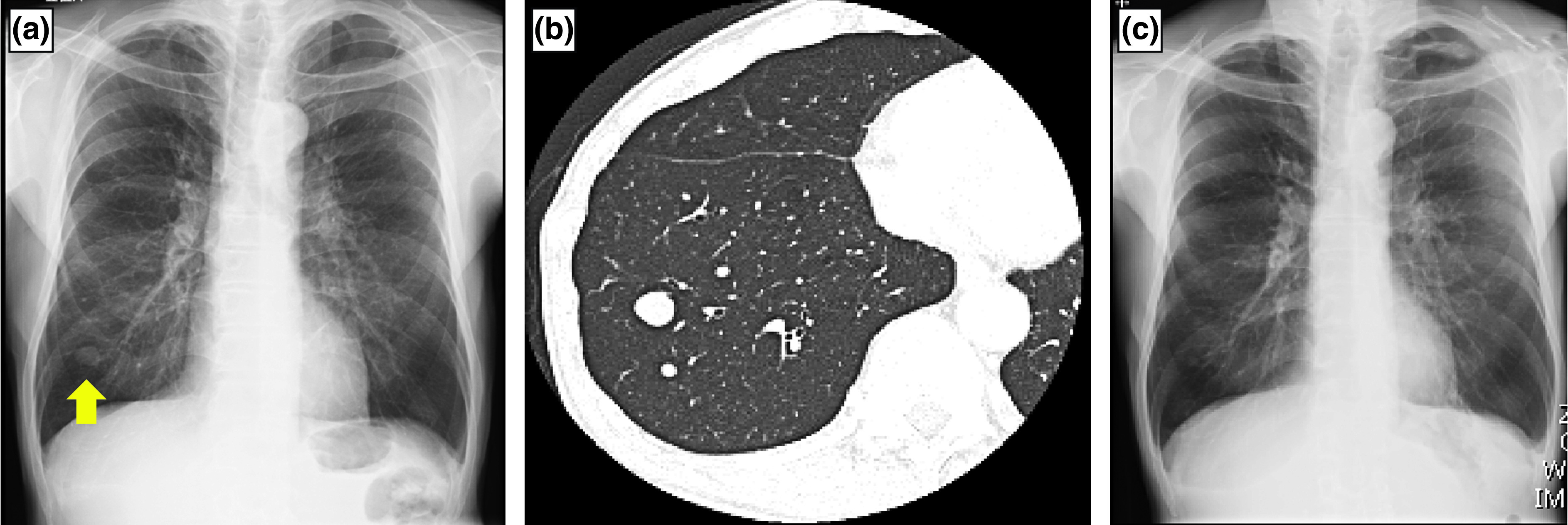 Resection of Pulmonary Metastases 12 Years after Initial Surgery for a Benign Pheochromocytoma.