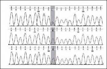 Autosomal dominant Ullrich congenital muscular dystrophy due to a <i>de novo</i> mutation in <i>COL6A3</i> gene. A case report.