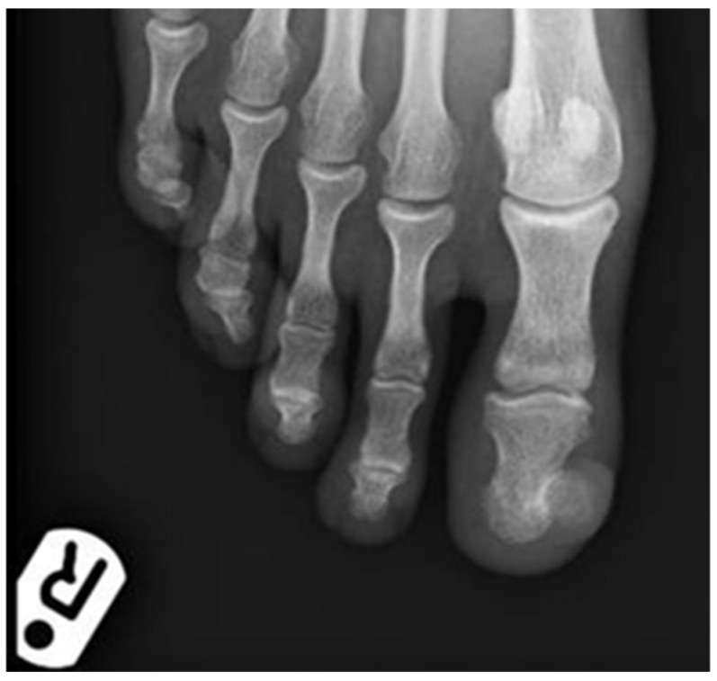 Subungual Exostosis Presenting as a Pyogenic Granuloma-like Lesion with Reactive Myofibroblastic Proliferation in Two Young Women.