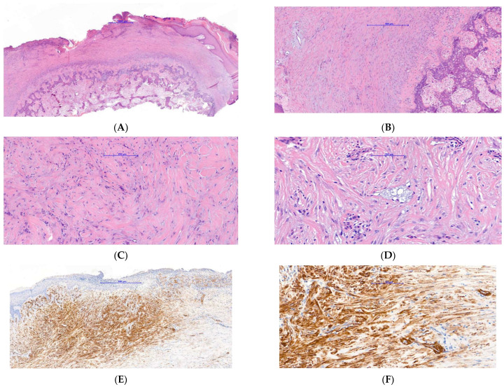 Subungual Exostosis Presenting as a Pyogenic Granuloma-like Lesion with Reactive Myofibroblastic Proliferation in Two Young Women.