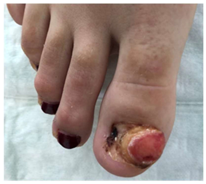 Subungual Exostosis Presenting as a Pyogenic Granuloma-like Lesion with Reactive Myofibroblastic Proliferation in Two Young Women.