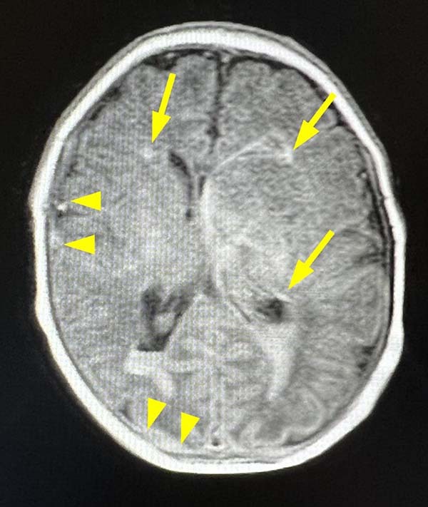 A COL4A1 variant in a neonate with multiple intracranial hemorrhages and congenital cataracts.