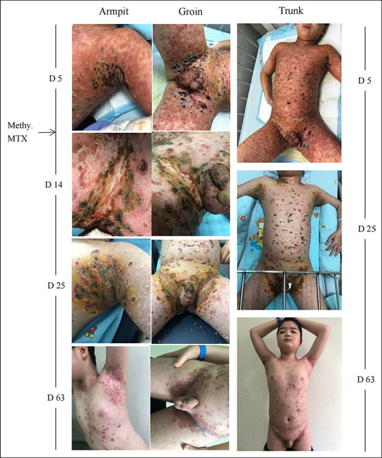 Febrile Ulceronecrotic Mucha-Habermann Disease: A Case Report and a Systematic Review.