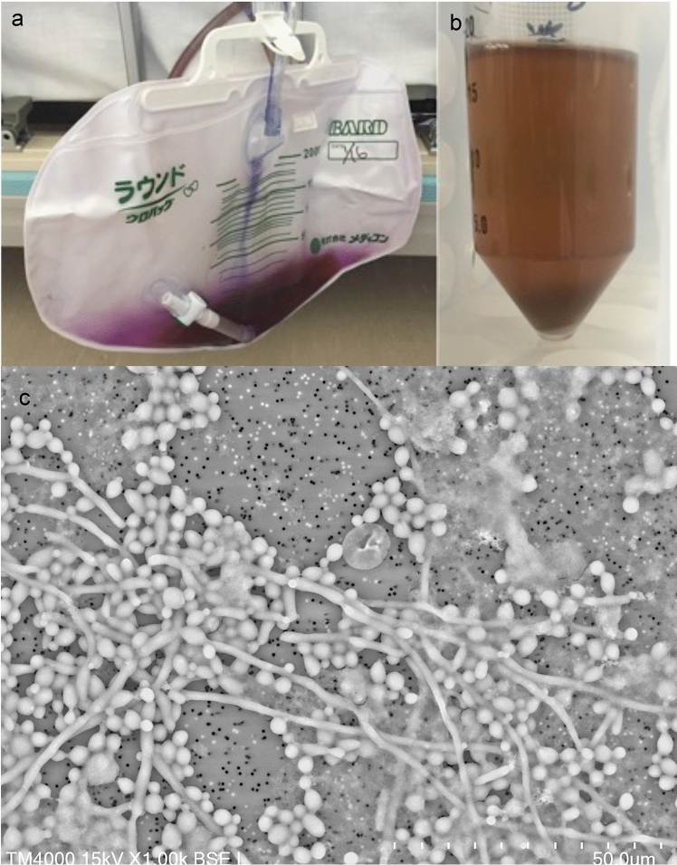 Analysis of purple urine bag syndrome by low vacuum scanning electron microscopy.