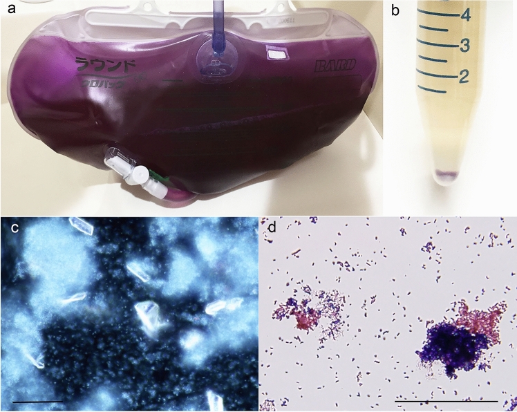 Analysis of purple urine bag syndrome by low vacuum scanning electron microscopy.