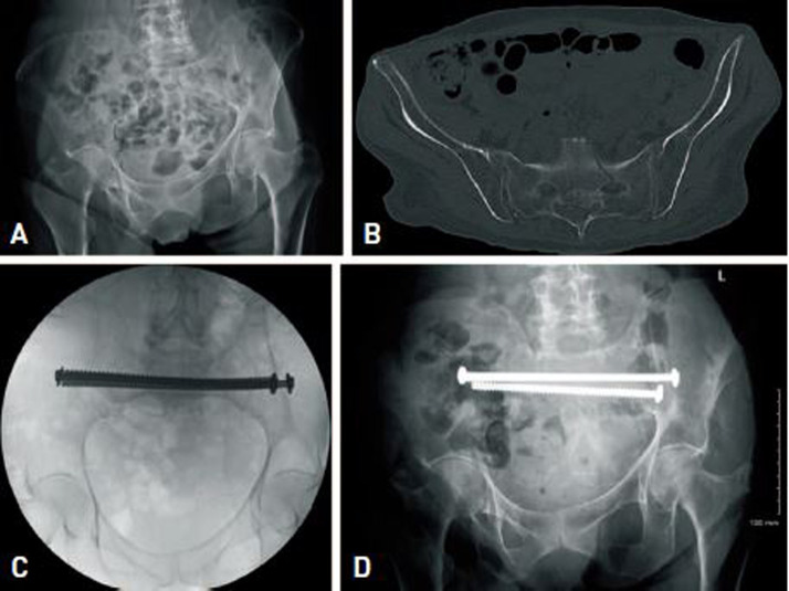 Fragility Fractures of the Pelvis and Sacrum: Current Trends in Literature.