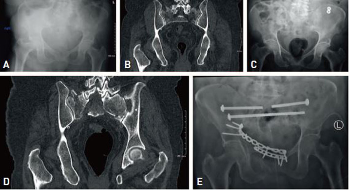 Fragility Fractures of the Pelvis and Sacrum: Current Trends in Literature.