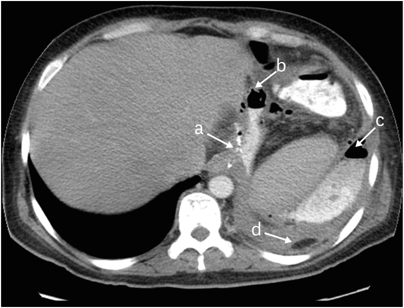 Diagnosis and Management of Postoperative Complications After Sleeve Gastrectomy.