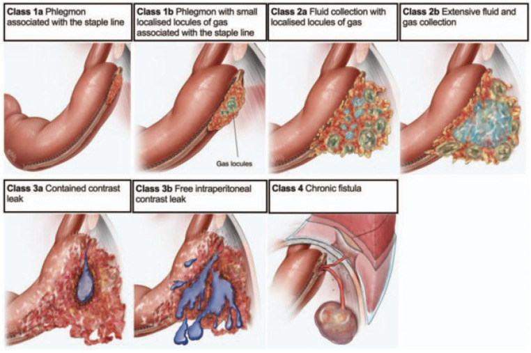 Diagnosis and Management of Postoperative Complications After Sleeve Gastrectomy.