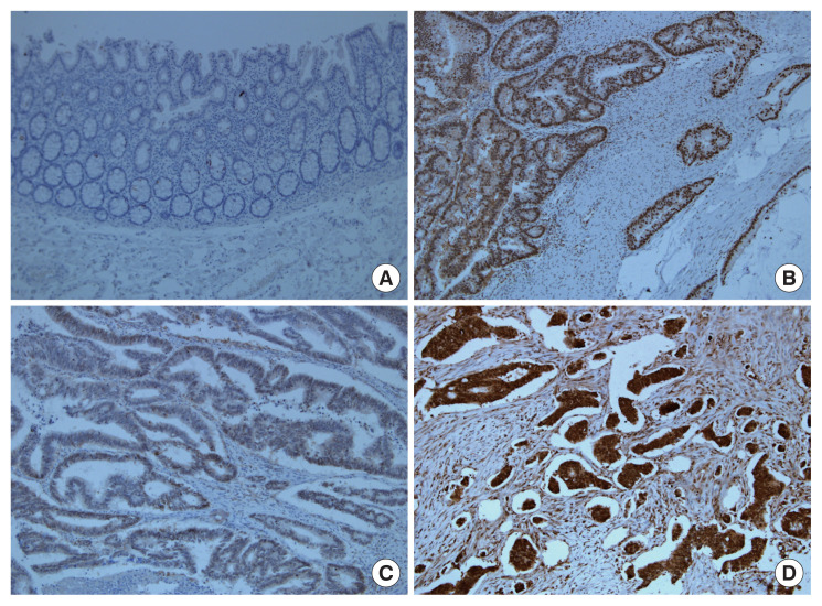 Apurinic/apyrimidinic endonuclease 1 is associated with poor prognosis after curative resection followed by adjuvant chemotherapy in patients with stage III colon cancer.