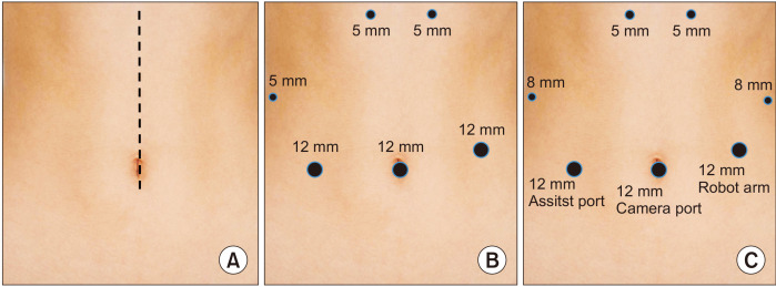 Which one will you choose; open, laparoscopic, or robotic transduodenal ampullectomy?: a case report.