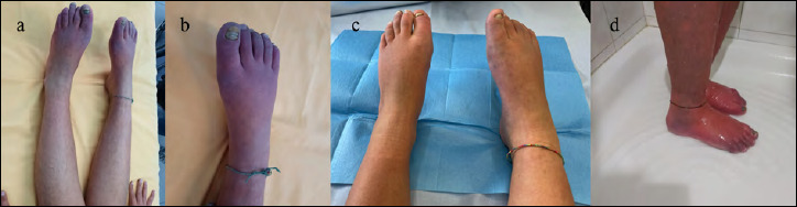 Peripheral circulation disturbances in two consecutive children with spinal muscular atrophy and literature review.