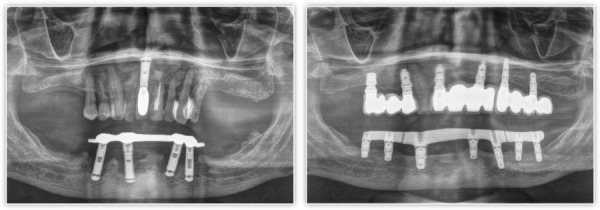 [Rehabilitation of a case with active periodontitis and advanced perii-implantitis. Minimally invasive approach].