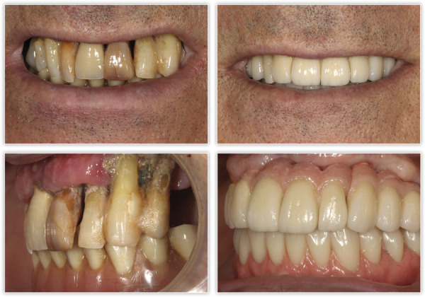 [Rehabilitation of a case with active periodontitis and advanced perii-implantitis. Minimally invasive approach].