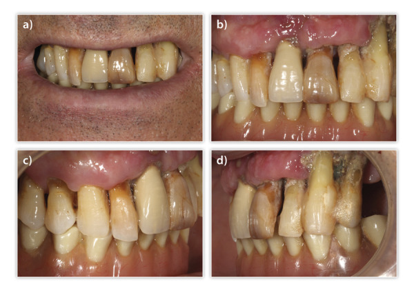[Rehabilitation of a case with active periodontitis and advanced perii-implantitis. Minimally invasive approach].
