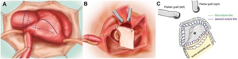 Root-commando operation for a ruptured left ventricular outflow tract.