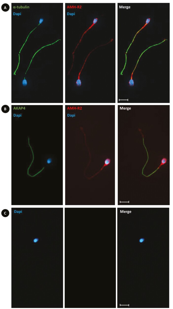 Defining Reference Ranges for Serum Anti-Müllerian Hormone on a Large Cohort of Normozoospermic Adult Men Highlights New Potential Physiological Functions of AMH on FSH Secretion and Sperm Motility.