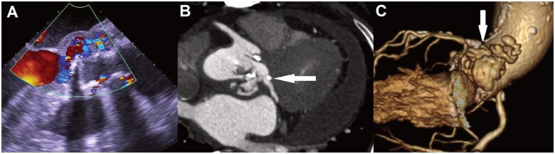 Root-commando operation for a ruptured left ventricular outflow tract.