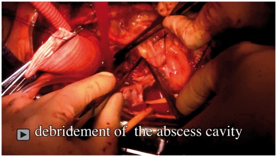 Root-commando operation for a ruptured left ventricular outflow tract.