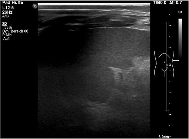 Extreme fetal macrosomia at 42 gestational weeks: a case report and literature review.