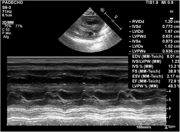 Extreme fetal macrosomia at 42 gestational weeks: a case report and literature review.