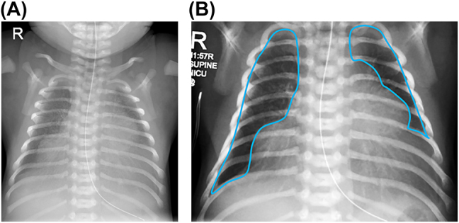 Physiological pulmonary assessments in the management of bilateral diaphragmatic eventration.