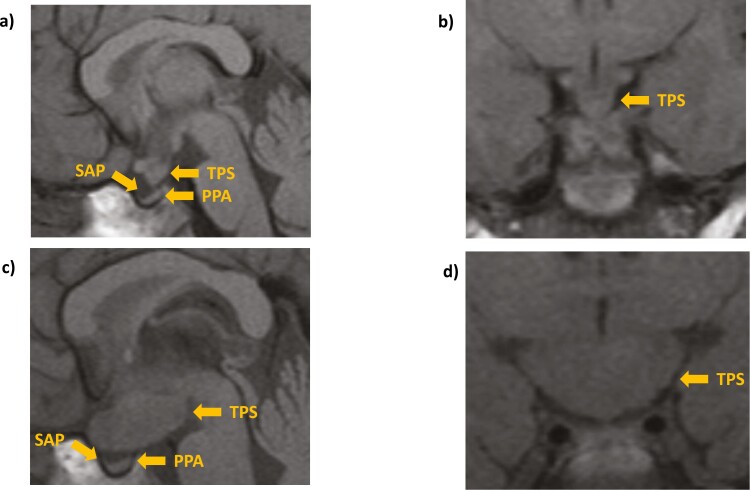 Approach to the Patient: Management of Pituitary Hormone Replacement Through Transition.