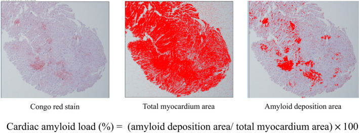 Correlation Between Cardiac Images, Biomarkers, and Amyloid Load in Wild-Type Transthyretin Amyloid Cardiomyopathy.
