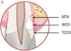 MTA Matrix Technique: Restoration of Teeth with Deep Subgingival Defects Extending Down to the Osseous Crest.