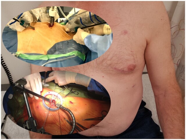 Early home discharge after robot-assisted coronary artery bypass grafting.