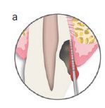 MTA Matrix Technique: Restoration of Teeth with Deep Subgingival Defects Extending Down to the Osseous Crest.