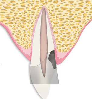 MTA Matrix Technique: Restoration of Teeth with Deep Subgingival Defects Extending Down to the Osseous Crest.