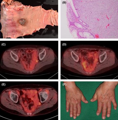 Recurrent advanced rectal malignant melanoma that discontinued anti-PD-1 antibody after complete response and was refractory to rechallenge