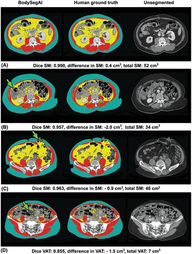 Body composition assessment by artificial intelligence from routine computed tomography scans in colorectal cancer: Introducing BodySegAI