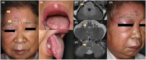 Involvement of the spinal trigeminal nucleus secondary to herpes zoster in a patient with hemifacial redness and swelling