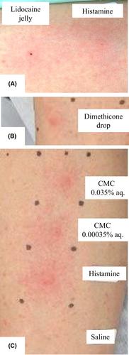 Immediate hypersensitivity reaction to carboxymethylcellulose in lidocaine jelly and dimethicone drops: A case report and mini-review