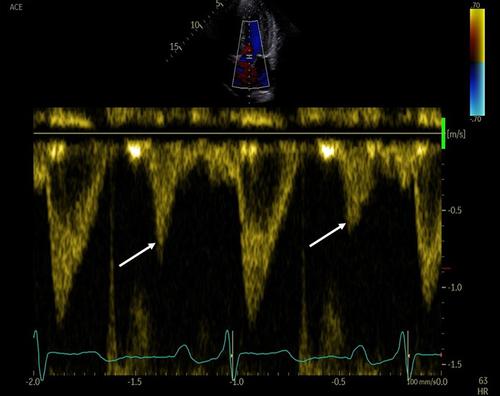 Diastolic flow in the left ventricular outflow tract – A normal physiological and underappreciated echocardiographic finding