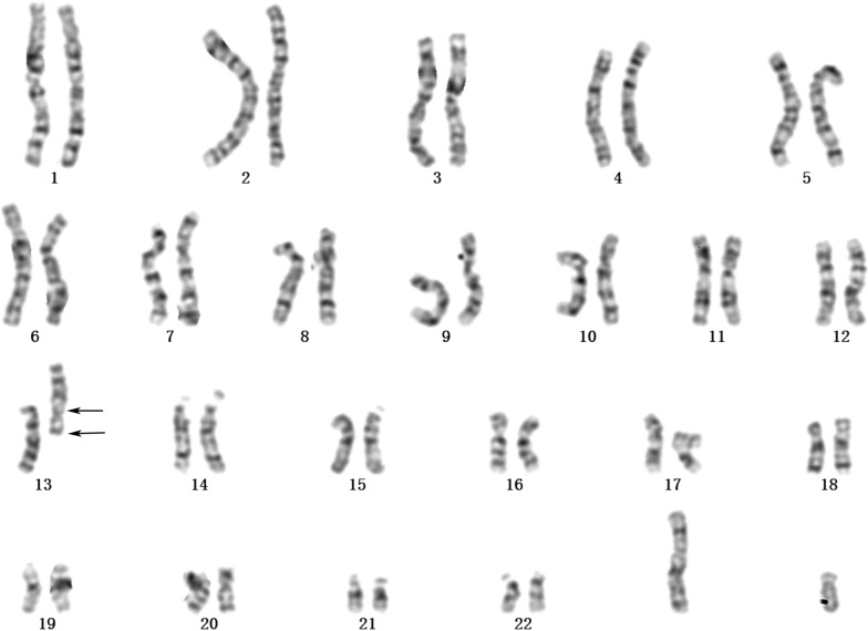 Identification of partial trisomy 13q in two unrelated patients using single-nucleotide polymorphism array and literature overview.