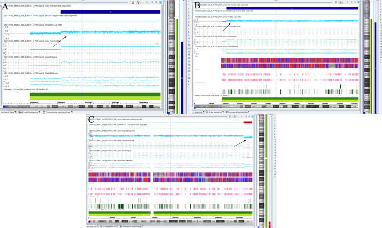 Identification of partial trisomy 13q in two unrelated patients using single-nucleotide polymorphism array and literature overview.