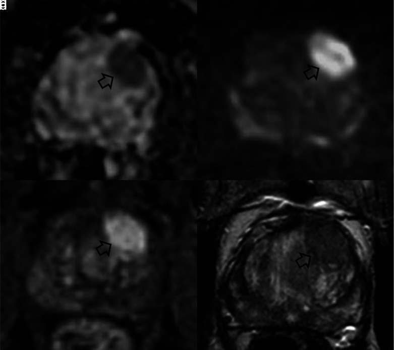 Lesion Volume in a Bi- or Multivariate Prediction Model for the Management of PI-RADS v2.1 Score 3 Category Lesions.